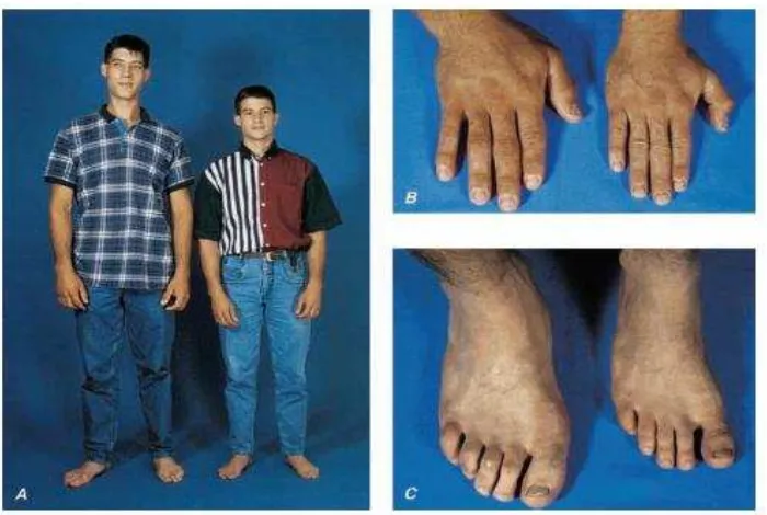 Gambar 2.  Gambar akromegali/gigantisme. Seorang laki-laki 22 tahun dengan gigantisme karena kelebihan GH pada sebelah kiri dari kembar identik