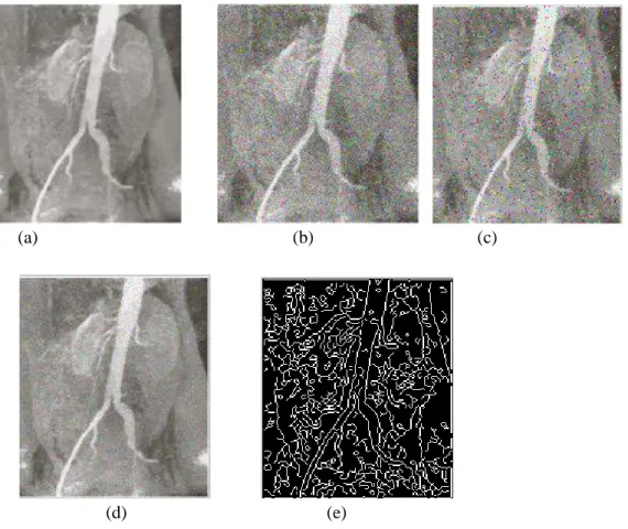 Gambar  4. (a) Image asli Aortic angiogram  , (b) Image dengan Gaussian noise , (c) Image  dengan salt &amp; pepper noise , (c) Image dengan poisson noise , (d) Pengaruh Noise ( salt &amp; 