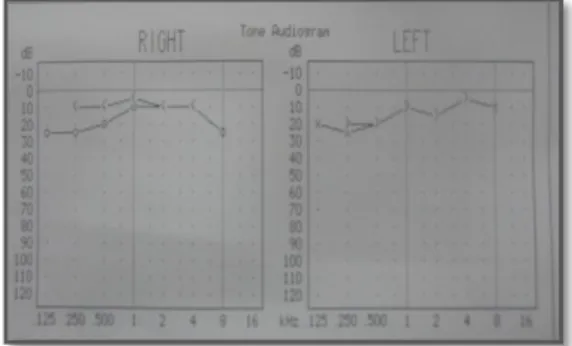 Gambar 5 : Audiometri pasien 7 minggu pasca  miringoplasti 