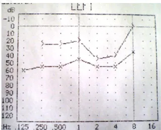 Gambar  3.  Hasil  audiometri  telinga  kiri  setelah  operasi (20 Agustus 2010) 