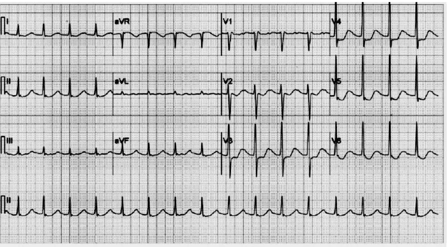 Gambar 3. EKG 12 sadapan memperlihatkan irama sinus takikardia, pemanjangan interval PR : 240 ms 