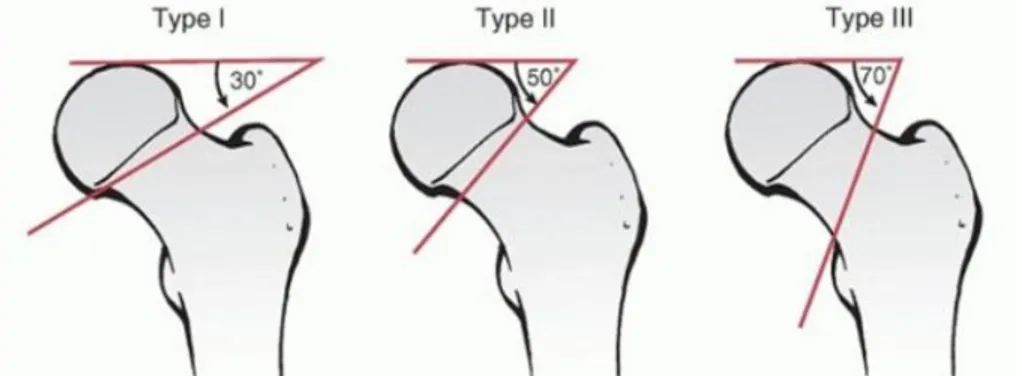 Gambar 8 : Klasifikasi Pauwel, Tipe 1 : &lt; 30˚, Tipe II : 30 - 50˚, Tipe III : &gt;  50˚