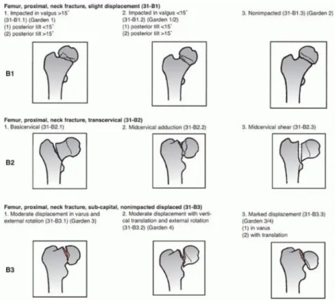 Gambar 9 : Klasifikasi AO/OTA pada fraktur collum femur