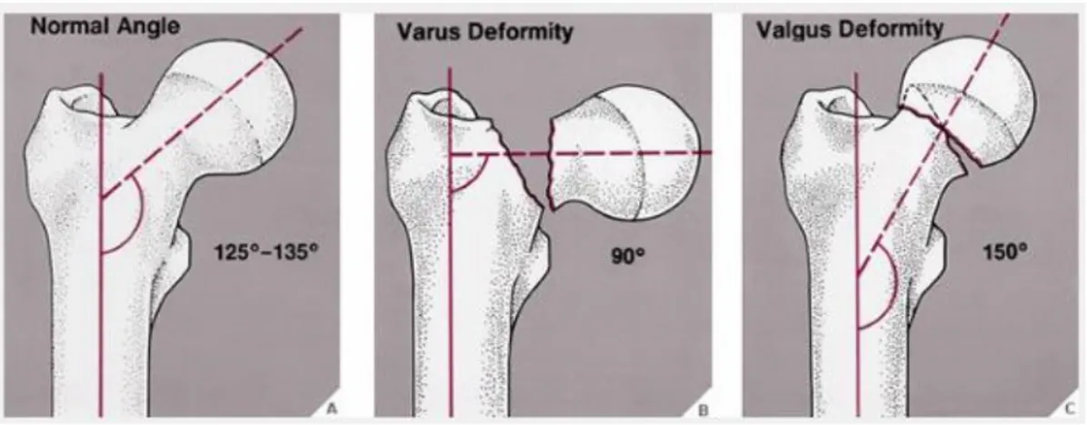 Gambar 2 : Bentuk varus dan valgus dari collum femur