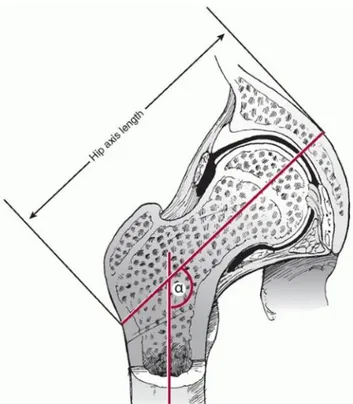 Gambar 3 : Hip Axis Length dan Neck Shaft Angle (α)