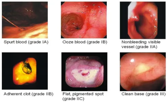 Gambar 2.Gambaran Endoskopi Aktivitas Perdarahan Ulkus peptikum Menurut Forest. 