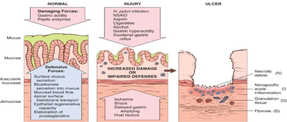 Gambar 1. Patogenesis Perdarahan Saluran Cerna bagian Atas. 
