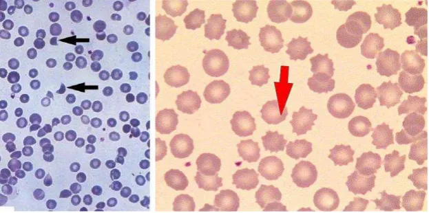 Gambar 4. Sel darah merah yang terfragmentasi/skistosit (Kiri) dan burr cell (Kanan) 