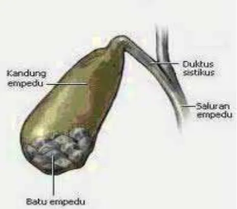 Gambar 2.3  Batu empedu pada kandung empedu 