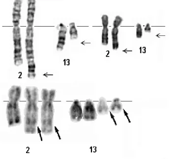 Gambar 1.  Translokasi kromosom t(2;13) 5 