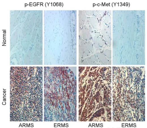 Gambar 2. Imunohistokimia pada alveolar dan embrional rabdomiosarkoma 8 