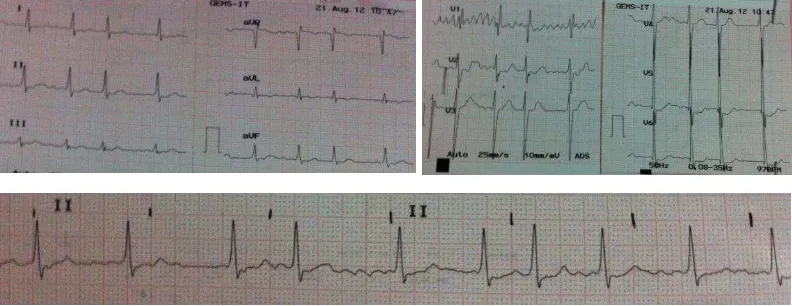 Gambar 2. Atrial fibrilasi 