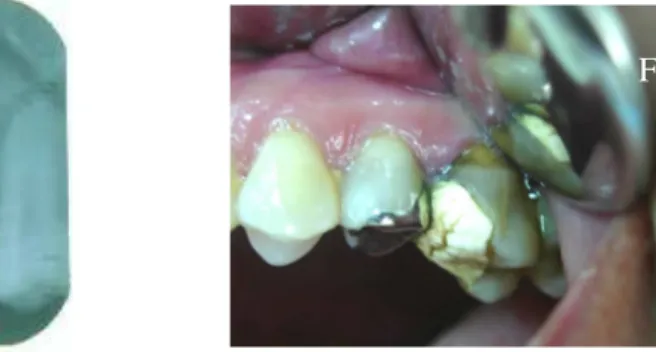 Gambar  4.  A,  Keadaan  gigi  setelah  perawatan  saluran  akar  terdahulu,  terlihat  pengisian  yang tidak hermetis dan adanya gambaran kistik di apikal