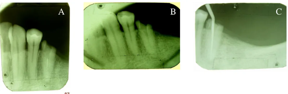 Gambar 1. A, Keadaan gigi setelah perawatan saluran akar terdahulu, terlihat pengisian  yang tidak hermetis dan adanya radiolusensi di apikal