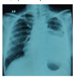 Gambar 1. Rontgen toraks pasien  diambil pada tannggal 19 Januari 