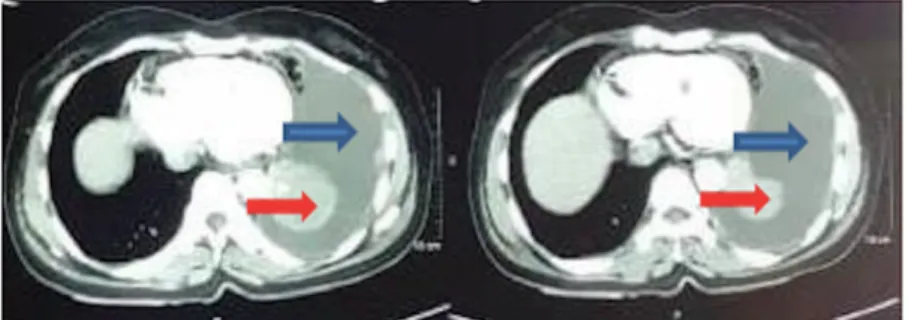 Gambar 2. Gambaran hasil CT scan thoraks dengan kontras di ambil  pada tanggal 26 Januari 2021 menunjukkan efusi pleura sinistra (panah  biru) dan terdapat gambaran massa di toraks bagian kiri (panah merah)  yang diduga paru kiri yang kolaps atau tumor par