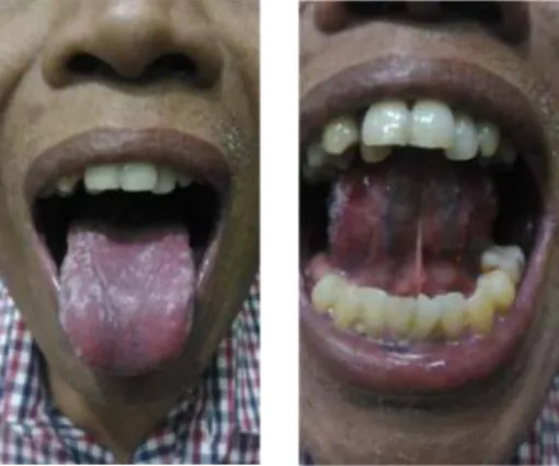 Gambar 1. Awal datang terdapat candida pada dorsal lidah dan inferior lidah           