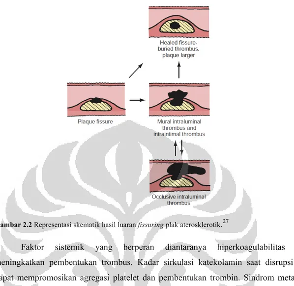 Gambar 2.2 Representasi skematik hasil luaran fissuring plak aterosklerotik . 27