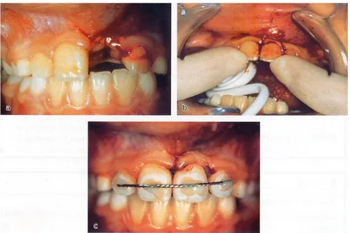Gambar 11. (a). Gigi insisif sentral kiri atas mengalami avulsi                                  (b)