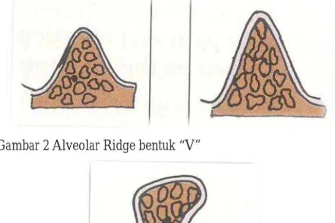 Gambar 1 Alveolar Ridge bentuk “U”