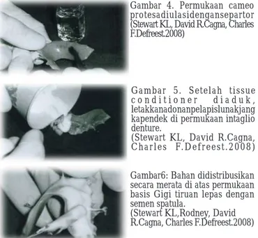 Gambar 4. Permukaan cameo protesadiulasidengansepartor (Stewart KL, David R.Cagna, Charles F.Defreest.2008)