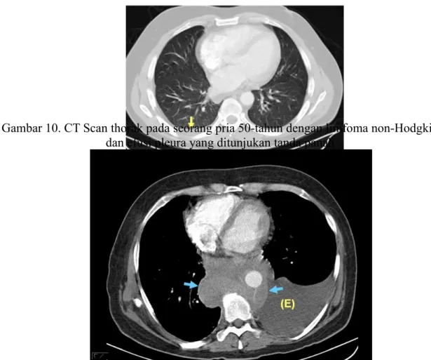 Gambar 10. CT Scan thorak pada seorang pria 50-tahun dengan limfoma non-Hodgkin dan efusi pleura yang ditunjukan tanda panah