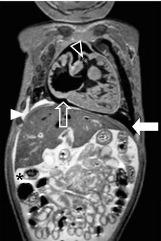 Gambar 15. Ultrasonogram dari kiri dada bagian bawah pada wanita 47 tahun dengan efusi pleura metastasis