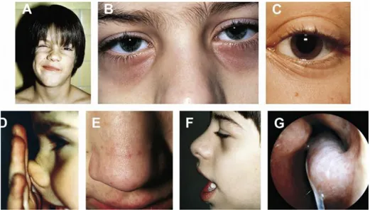 Gambar 2.2 Temuan pada pemeriksaan fisik rinitis alergi. (a) facial grimacing or twitching (gatal  pada  hidung)  (b)  allergic  shiners