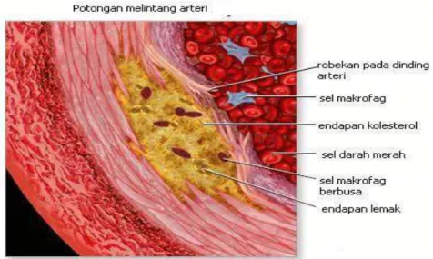 Gambar 2.2. Potongan Melintang Arteri pada Aterosklerosis  Dikutip dari: Aterosklerosis