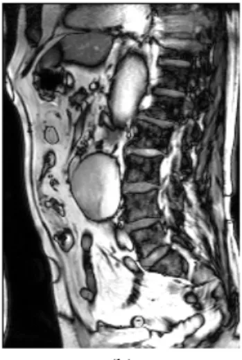 Gambar 3.2 Citra koronal MRI dan citra hasil implementasi ITF  Pada  Gambar  3.2  diberikan  hasil 