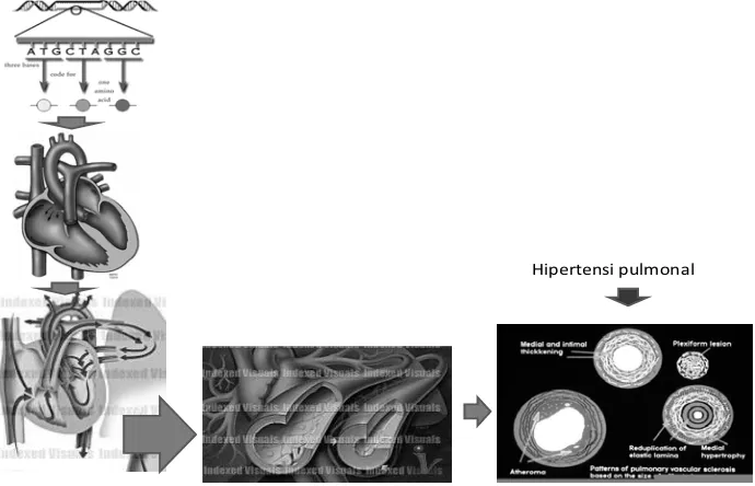 Gambar 1. Patomekanisme mutasi gen pada DSA sekundum yang menyebabkan hipertensi pulmonal