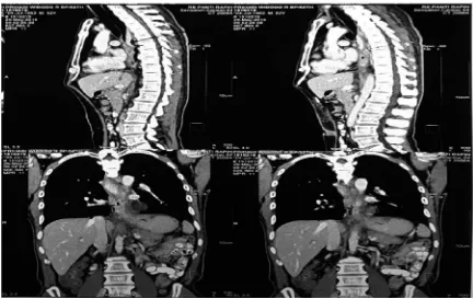 FIGURE 2. First CT scan (29 Mei 2015) showed narrowing of esophagus on the level of 7th thoracic ver-tebra.