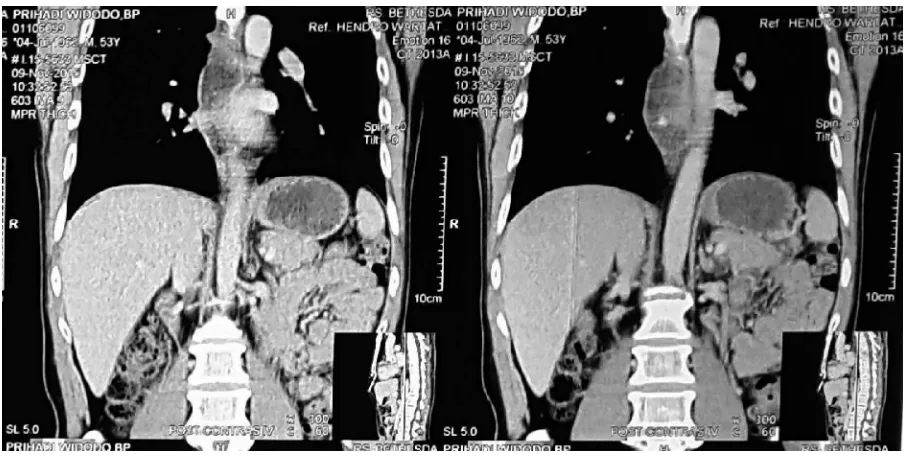 FIGURE 3. Second CT scan (17 September 2015), CT coronal view showed intraluminal tumor of esophagus causing total obstruction on the level of 9th thoracic vertebra.