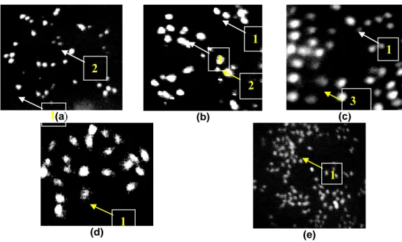 Gambar  3–Morfologi sel T47D akibat perlakuan ekstrak (a) konsentrasi 200µg/ml (b) 300 µg/ml (c) 400 µg/ml (d) kontrol  pelarut  dan  (e)  kontrol  sel,  setelah  pengecatan  dengan  menggunakan  double  staining  akridin  oranye-etidium  bromida