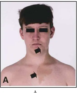 Gambar 12. Asimetri wajah terlihat pada maksila kiri terlihat juga pigmentasi kulit pada wajah dan leher (pasien yang sama dengan gambar  8).2  
