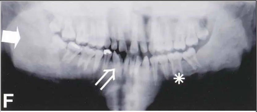 Gambar 16.  Gambaran panoramik fibrous displasia menunjukkan daerah ground glass pada sisi kanan         dan kiri, serta radiopaque pada mandibula kiri.2   