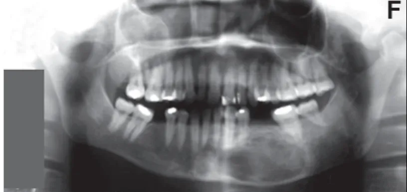 Gambar 18. Gambaran radiografi foto panoramik ini menunjukkan dengan gambaran ground glass pada daerah anterior mandibula dan gambaran radiolusen pada daerah mixed density.3    