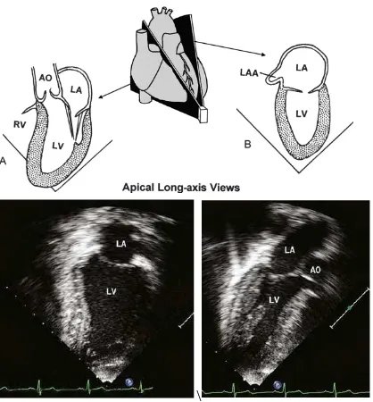 Gambar 9. Gambaran Pandangan apical two-chamber dan three-chamber