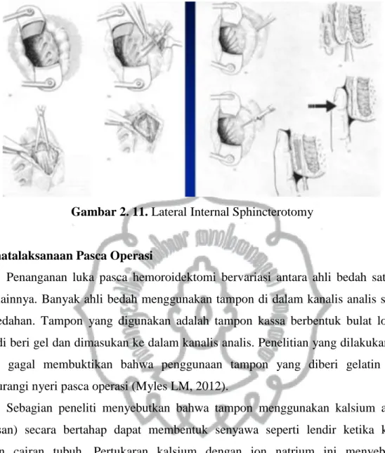 Gambar 2. 11. Lateral Internal Sphincterotomy 