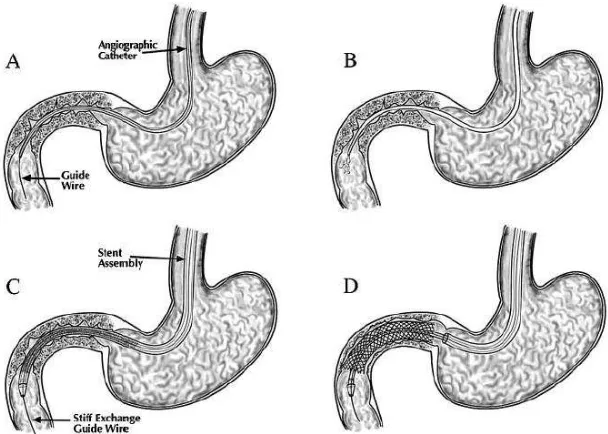Gambar 3. Diagram pemasangan gastroduodenal stent 