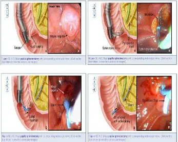 Gambar 4. Diagram pemasangan pancreatic stent 