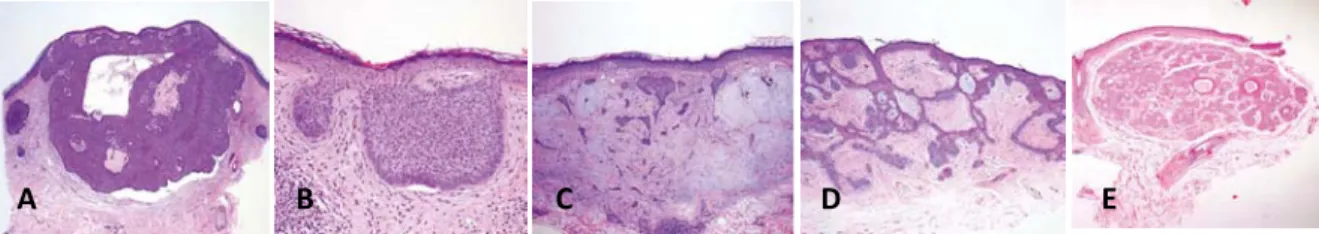 Gambar 3.  Gambaran histopatologik  basalioma .  A, Tipe nodular. B, Tipe  superfisial