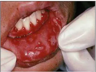 Gambar 5. Oral herpes simpleks18 
