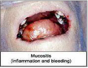 Gambar 6. Oral Mukositis18