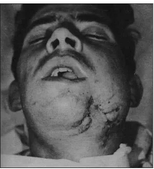 Gambar 7. Paresthesia18 