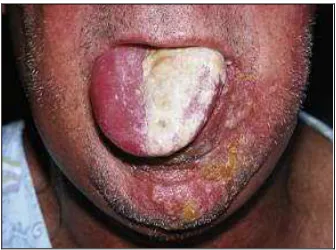 Gambar 8. Oral herpes zoster18