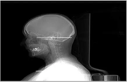 Gambar 11. Temporomandibular joint20 