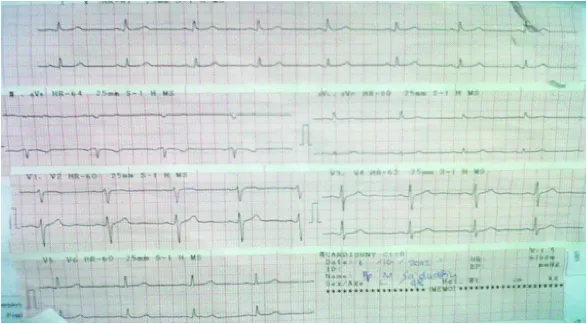 FIGURE 1.ECG recordings at the time of admission showed sinusrhythm and no ST-T changes