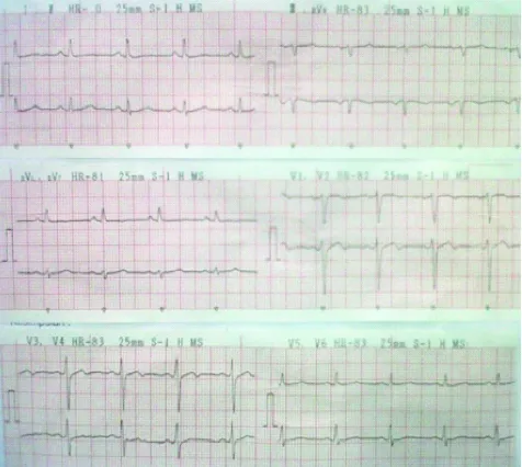 FIGURE 4.Electrocardiograph recordings showed sinusrhythm with slight ST elevation and T waveinversion in leads V2-V3