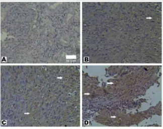 FIGURE 1. Immunohistochemistry staining of latent membrane protein 1 in NPC biopsies. Positive LMP-1 expression was